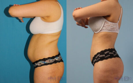 Brazilian Butt Lift case #4821