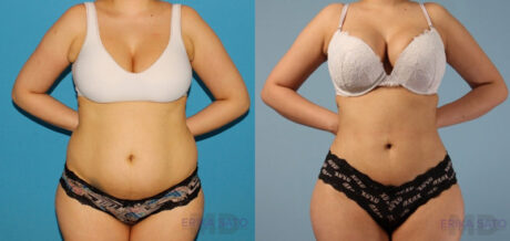 Brazilian Butt Lift case #4821