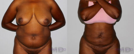 Liposuction case #5829