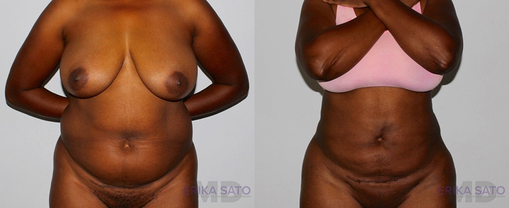 Liposuction case #5829