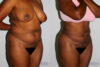 Liposuction case #5829 slider thumbnail