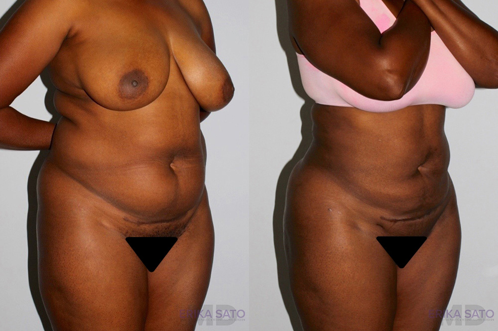 Liposuction case #5829