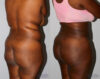 Liposuction case #5829 slider thumbnail