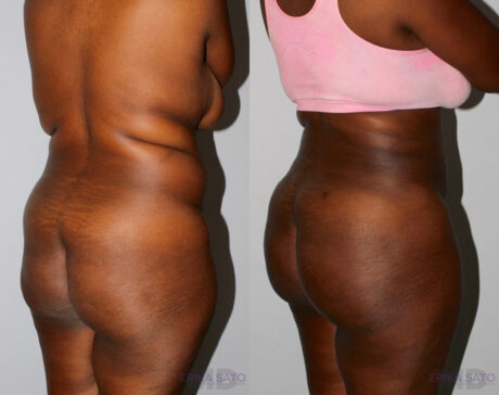 Liposuction case #5829