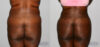 Liposuction case #5829 slider thumbnail