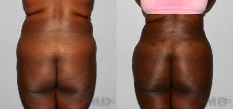 Liposuction case #5829