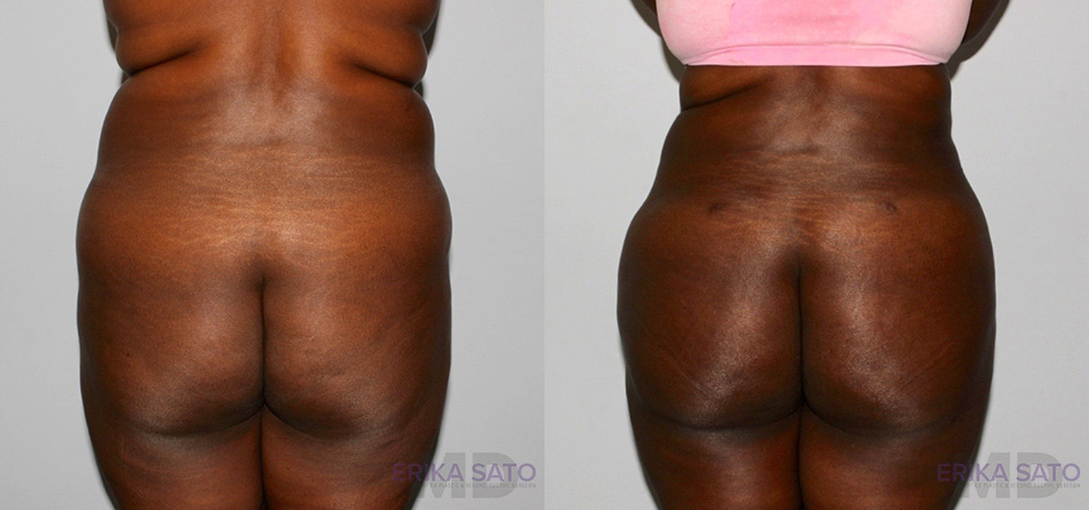 Liposuction case #5829
