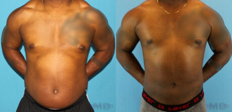 Liposuction case #5966