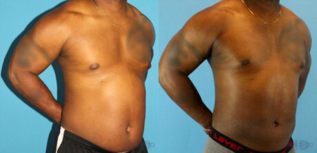 Liposuction case #5966