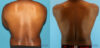 Liposuction case #5966 slider thumbnail