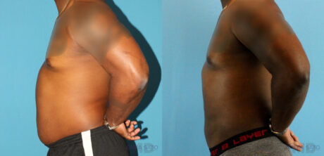 Liposuction case #5966