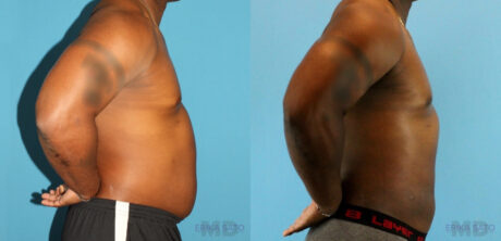 Liposuction case #5966