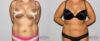 Liposuction case #5828 slider thumbnail