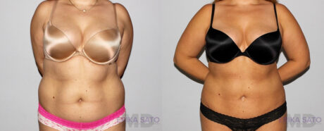 Liposuction case #5828