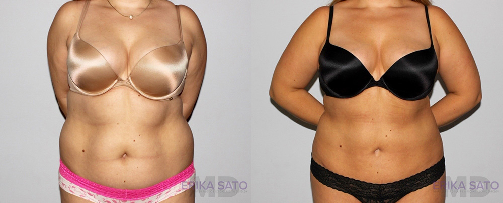 Liposuction case #5828
