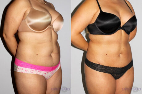 Liposuction case #5828