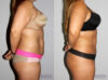 Liposuction case #5828 slider thumbnail