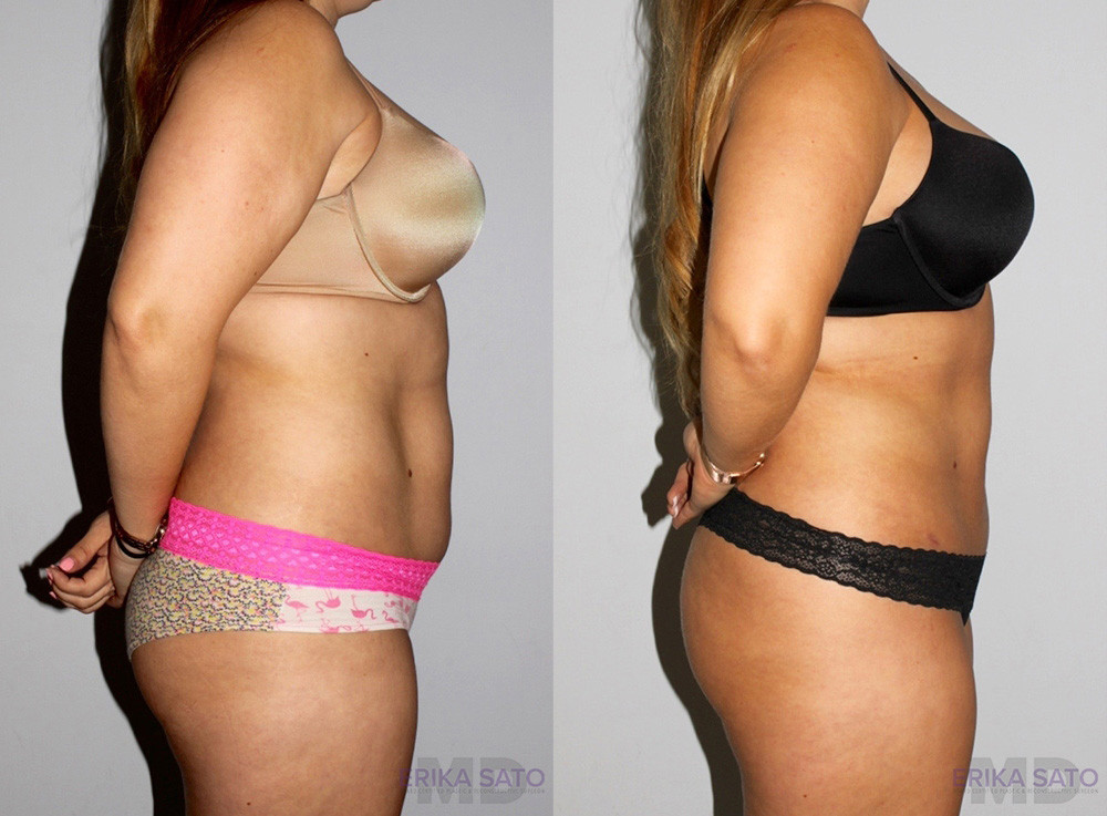 Liposuction case #5828