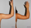 Liposuction case #5827 slider thumbnail