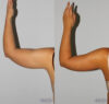 Liposuction case #5827 slider thumbnail