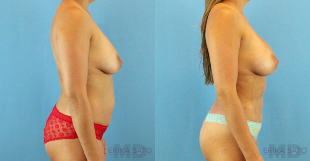 Fat Grafting to the Breast case #256167
