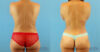Fat Grafting to the Breast case #256167 slider thumbnail