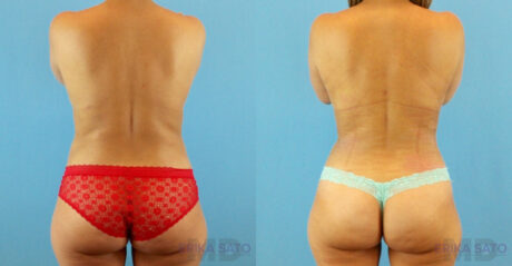 Fat Grafting to the Breast case #256167