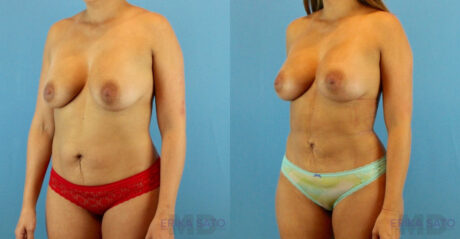 Fat Grafting to the Breast case #256167