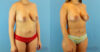 Fat Grafting to the Breast case #256167 slider thumbnail