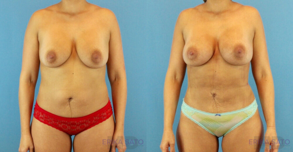 Fat Grafting to the Breast case #256167