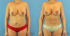 Fat Grafting to the Breast case #256167 slider thumbnail
