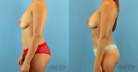 Fat Grafting to the Breast case #256167