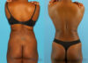 Tummy Tuck case #7341 slider thumbnail