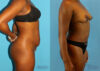 Tummy Tuck case #7341 slider thumbnail
