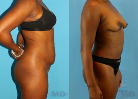 Tummy Tuck case #7341