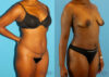Tummy Tuck case #7341 slider thumbnail
