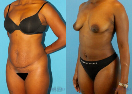 Tummy Tuck case #7341