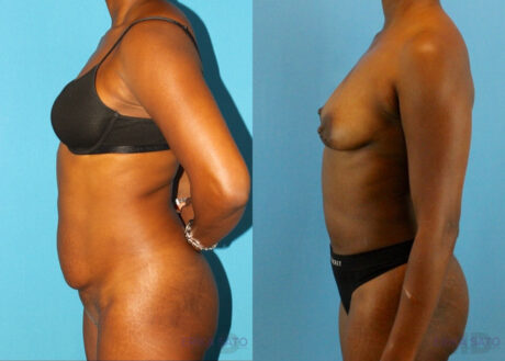 Tummy Tuck case #7341