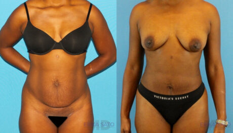 Tummy Tuck case #7341