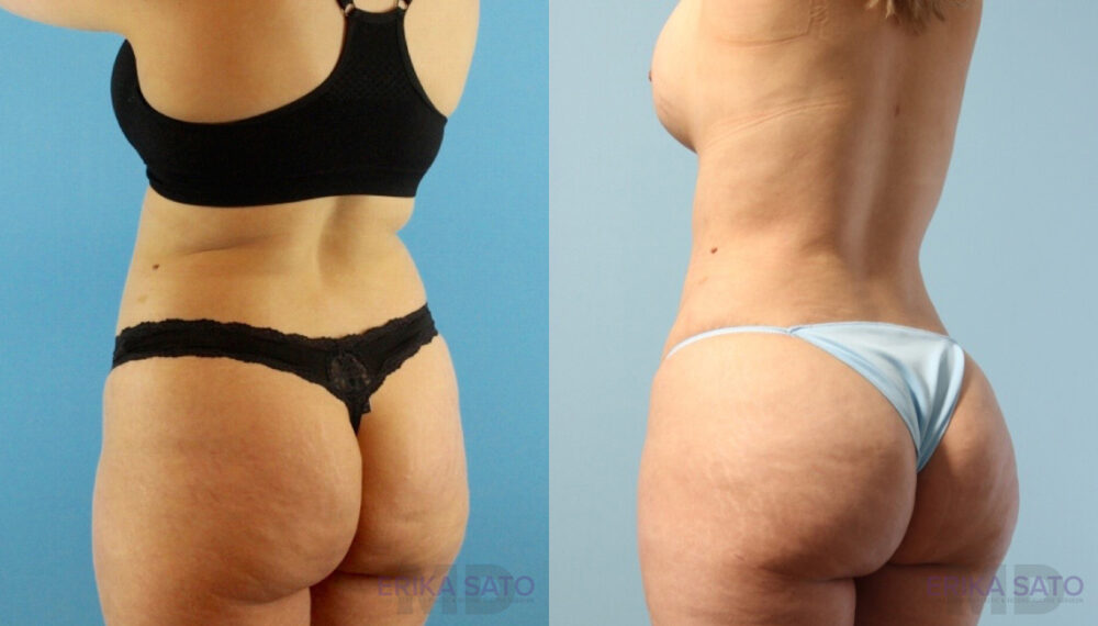 Brazilian Butt Lift case #4882