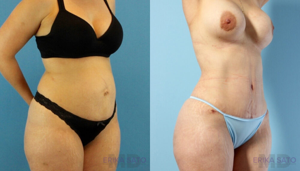 Brazilian Butt Lift case #4882
