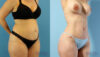 Brazilian Butt Lift case #4882 slider thumbnail