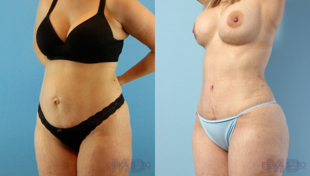 Brazilian Butt Lift case #4882