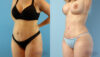 Brazilian Butt Lift case #4882 slider thumbnail