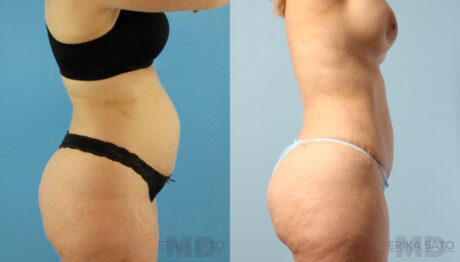 Brazilian Butt Lift case #4882