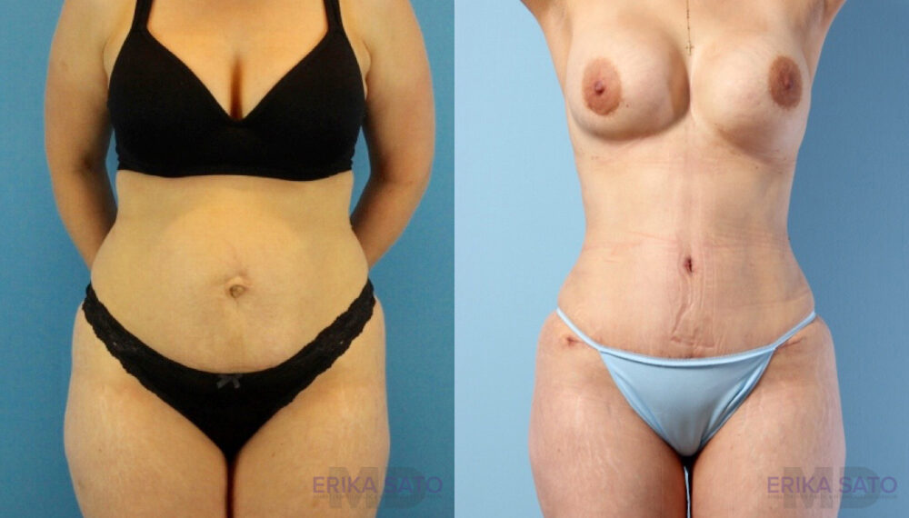 Brazilian Butt Lift case #4882