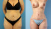 Brazilian Butt Lift case #4882 slider thumbnail