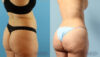 Brazilian Butt Lift case #4882 slider thumbnail