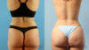 Brazilian Butt Lift case #4882 slider thumbnail