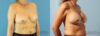 Breast Augmentation case #6297 slider thumbnail